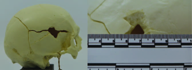 ballistic impact in cranium